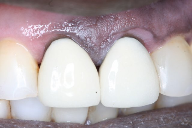 Crowns Before